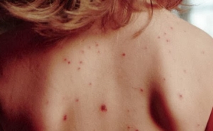 Direção-Geral de Saúde preocupada com casos de sarampo em Portugal