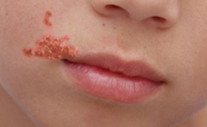 IMPETIGO: INFEÇÃO BACTERIANA CUTÂNEA ALTAMENTE CONTAGIOSA É MAIS COMUM NO VERÃO