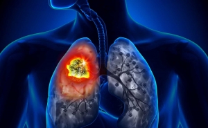 Cancro do Pulmão é o que mais mata em todo o mundo