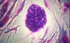 Nova direção para o tratamento dos vários tipos de cancro