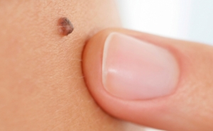 Testemunhas de cancro da pele reúnem-se no sábado para sensibilizar a população