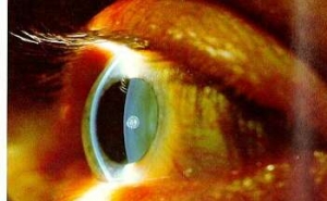 Retinopatia Diabética grave é a principal causa de cegueira irreversível abaixo dos 60 anos