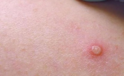 Portugal com 633 casos confirmados de infeção pelo vírus Monkeypox