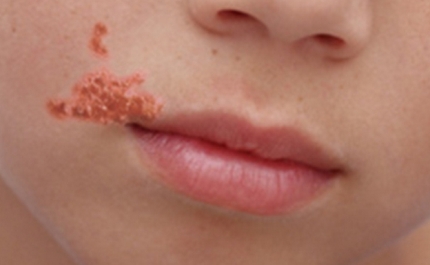 IMPETIGO: INFEÇÃO BACTERIANA CUTÂNEA ALTAMENTE CONTAGIOSA É MAIS COMUM NO VERÃO