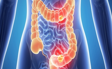 Sociedade Portuguesa de Gastrenterologia reforça urgência para a prevenção do cancro do intestino