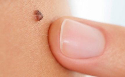 Testemunhas de cancro da pele reúnem-se no sábado para sensibilizar a população