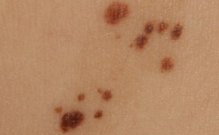 Tavira Gran-Plaza participa em ação de sensibilização – Prevenção do Melanoma