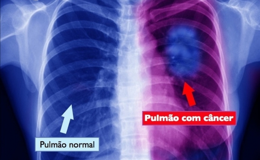 Cancro do pulmão: é melhor prevenir que remediar