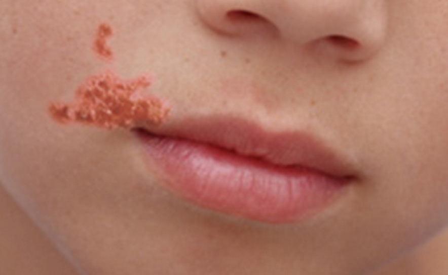 IMPETIGO: INFEÇÃO BACTERIANA CUTÂNEA ALTAMENTE CONTAGIOSA É MAIS COMUM NO VERÃO