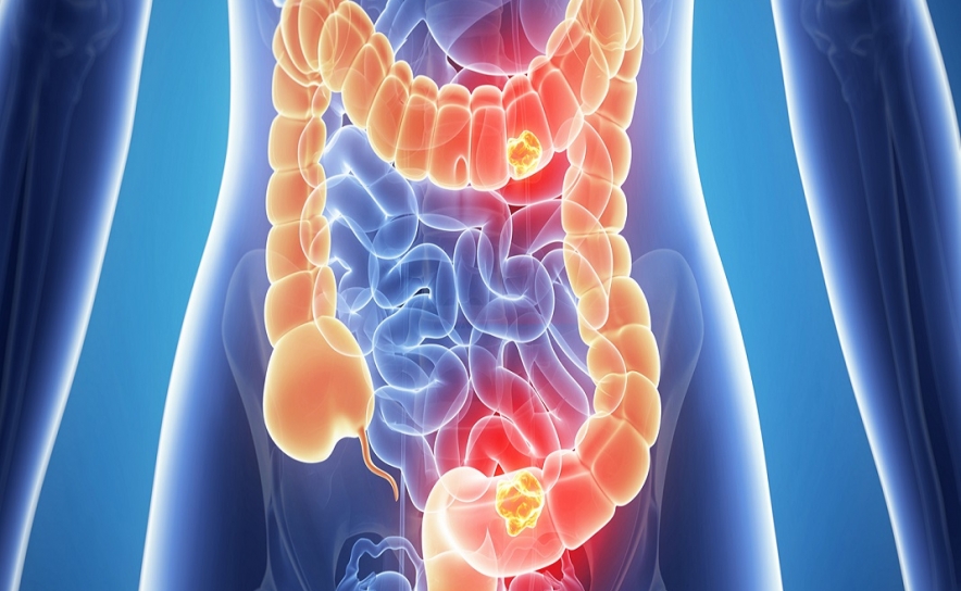 Sociedade Portuguesa de Gastrenterologia reforça urgência para a prevenção do cancro do intestino