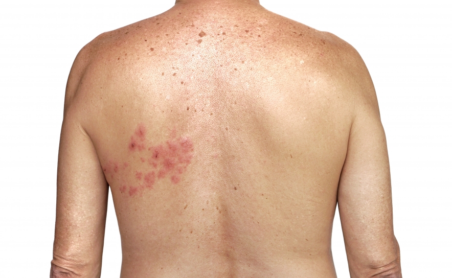 Altas temperaturas podem favorecer a Zona: saiba como prevenir